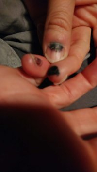 drei gequetschte Finger: kleiner Finger, Mittelfinger und schwarzer Daumennagel